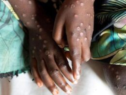 Mpox Is Not the New Covid- WHO Expert Reassures Amid New Variant Concerns Mpox Is Not the New Covid- WHO Expert Reassures