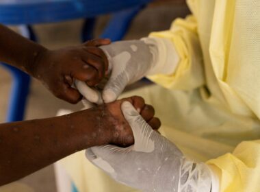 The National Primary Health Care Development Agency (NPHCDA) has announced that vaccination against Mpox in Nigeria will commence on October 8, 2024