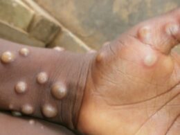 Rivers State Confirms Two Cases of Mpox
