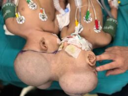 3D Technology Helps London Surgeon Separate Conjoined Twins