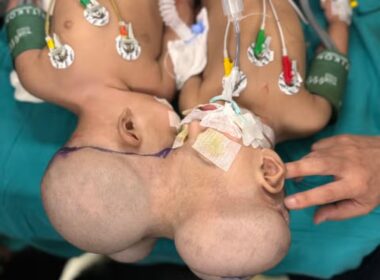 3D Technology Helps London Surgeon Separate Conjoined Twins