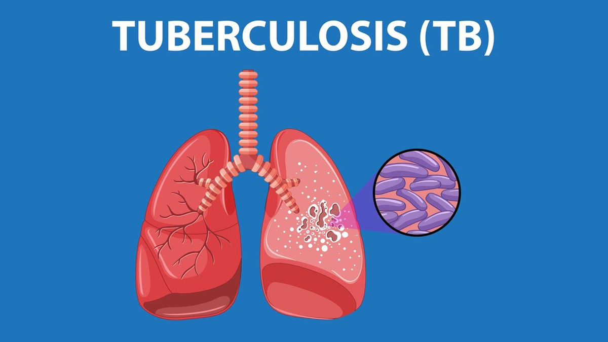 WHO Prequalifies Groundbreaking Tuberculosis Test