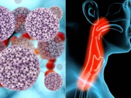 Shocking Truth: Oral Sex and HPV Are Causing Surge In Throat Cancer Shocking Truth: Oral Sex and HPV Are Driving a Surge in Throat Cancer Cases