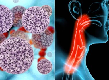 Shocking Truth: Oral Sex and HPV Are Driving a Surge in Throat Cancer Cases