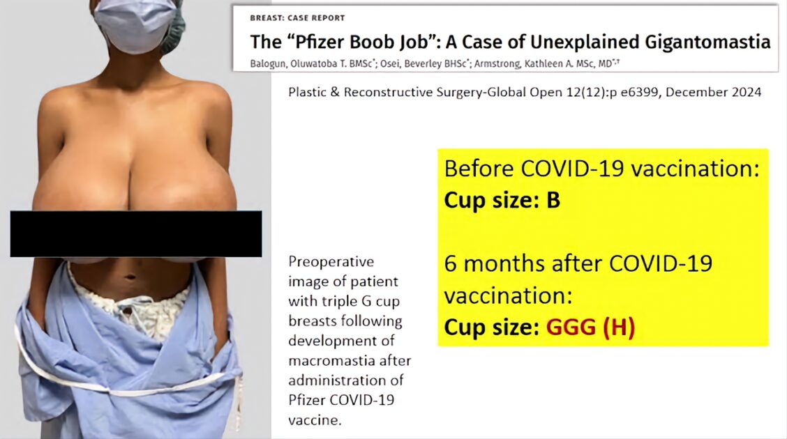 From a B-cup to a triple-G bra size.